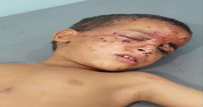 مقذوف عشوائي للحوثيين يصيب طفلين بالجوف.. صورة