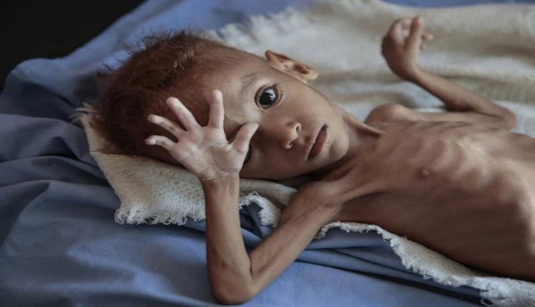 مسؤول أممي يحذر من خطورة انتشار الكوليرا في اليمن 
