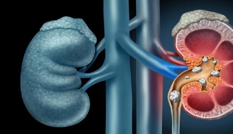 أطعمة تحفز تكون الحصوات في الكليتين